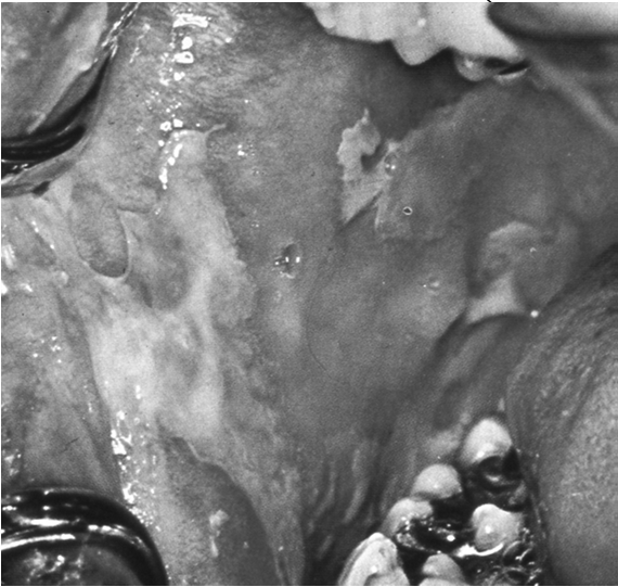 EM majus (ectodermosi erosiva pluriorifiziale di Stevens-Johnson) ERITEMA MULTIFORME DIAGNOSI Clinica: accurata anamnesi (es.