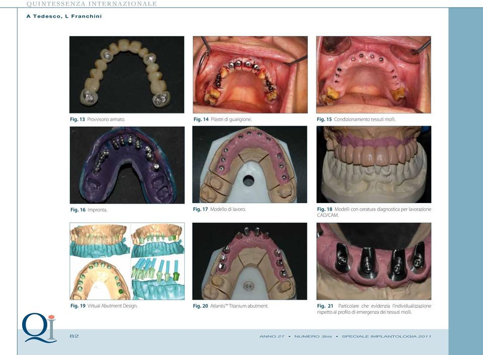 Fig. 20 Atlantis Titanium abutment. Fig.