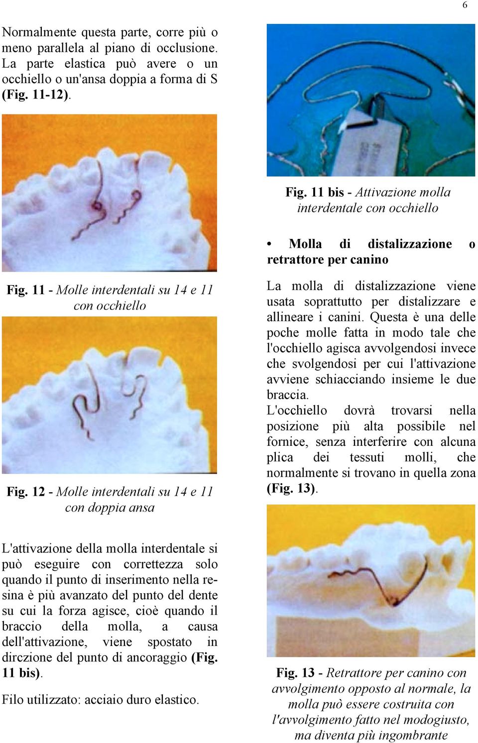 12 - Molle interdentali su 14 e 11 con doppia ansa La molla di distalizzazione viene usata soprattutto per distalizzare e allineare i canini.