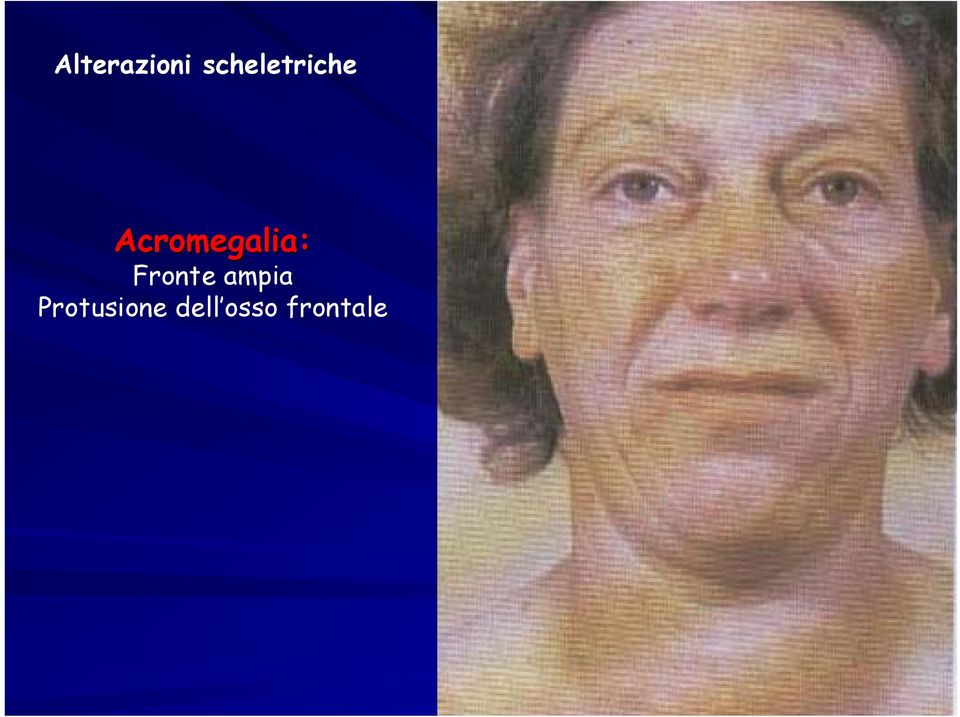 Acromegalia: Fronte