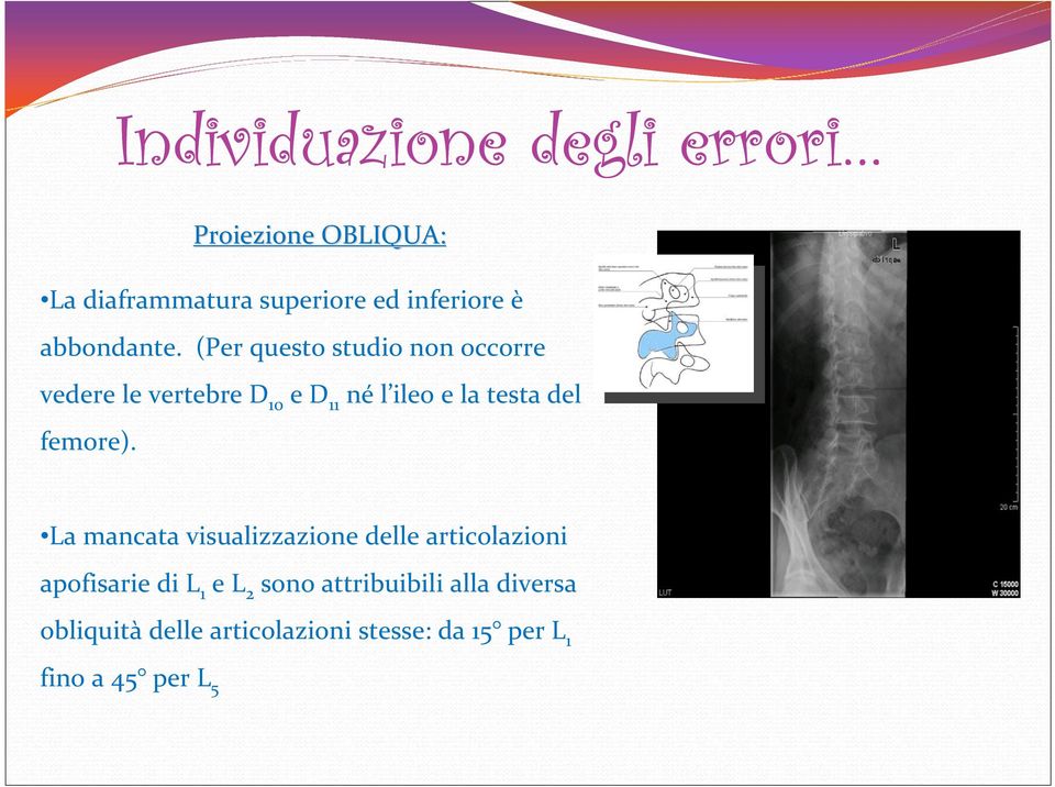 (Per questo studio non occorre vedere le vertebre D 10 e D 11 né l ileo e la testa del