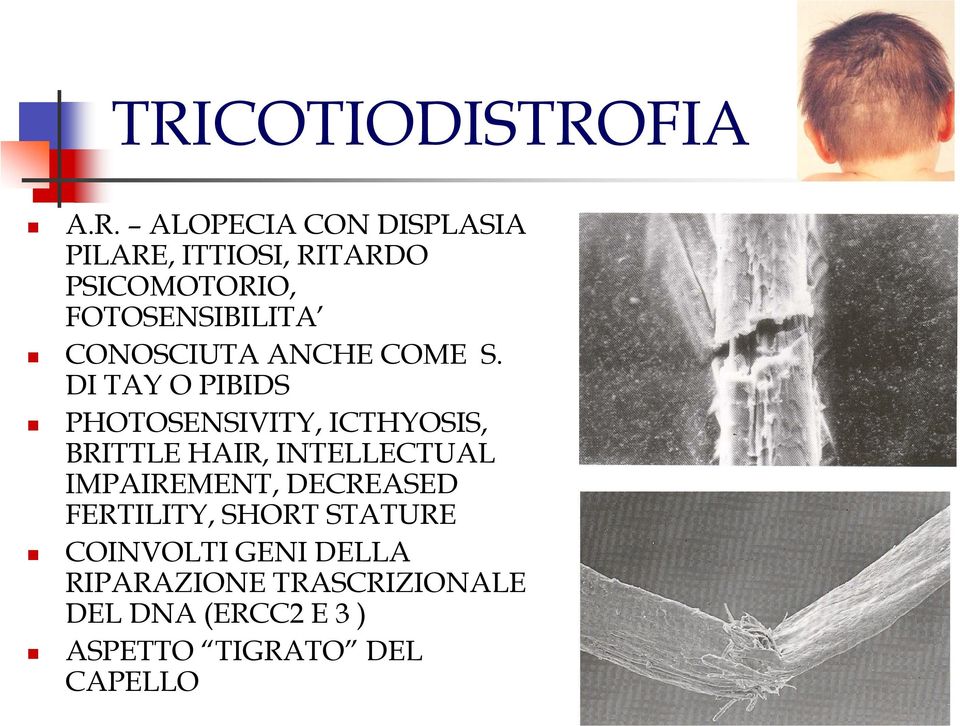 DI TAY O PIBIDS PHOTOSENSIVITY, ICTHYOSIS, BRITTLE HAIR, INTELLECTUAL IMPAIREMENT,