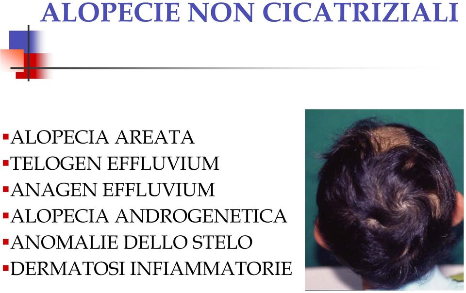 EFFLUVIUM ALOPECIA ANDROGENETICA