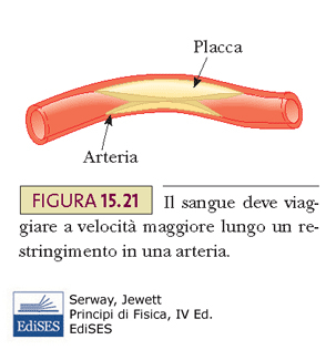 Stenosi ed aneurisma Flutter vascolare: sintomo dell arteriosclerosi avanzata. Si forma una placca che ostruisce parzialmente l arteria. Aumenta la velocità, diminuisce la pressione.