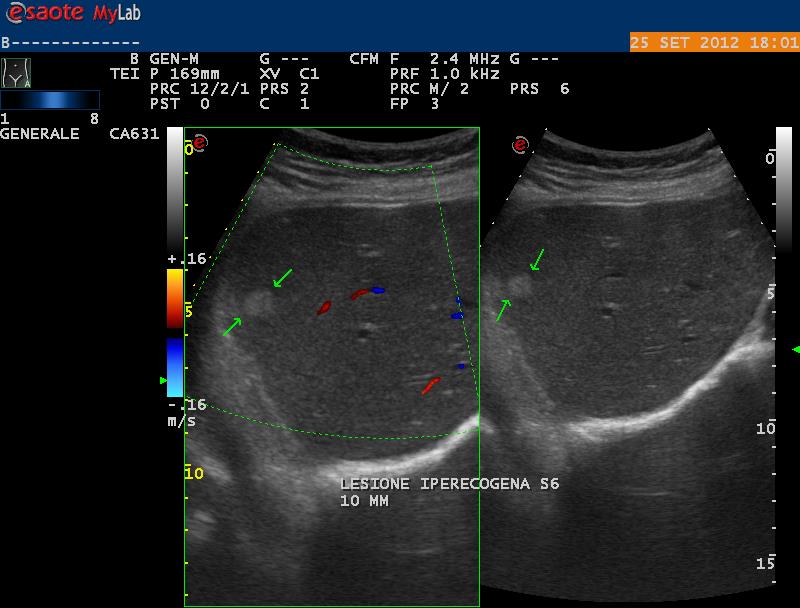 Lesione focale iperecogena lobo dx Lesione