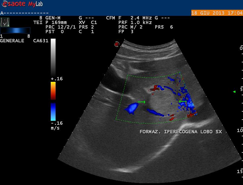Lesione focale iperecogena Lesione focale