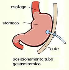 alimentazione per os Introito alimentare minimo Insufficiente grado
