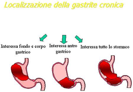 Gastrite ASPETTI CLINICI L'H. pylori è l'agente eziologico più importante della gastrite cronica "aspecifica".