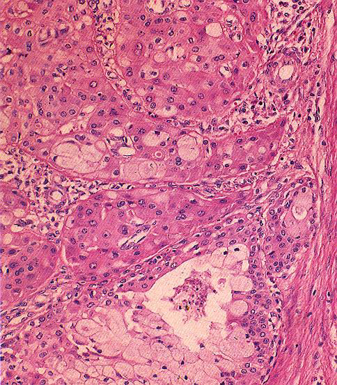 CARCINOMA MUCOEPIDERMOIDE Histology Low-grade - Mucus cell >