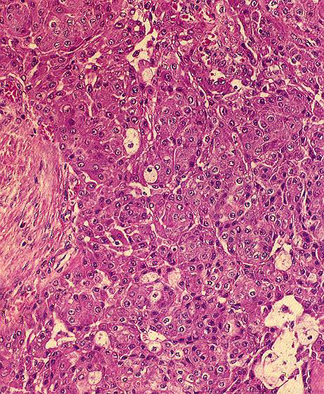 CARCINOMA MUCOEPIDERMOIDE Histology Intermediategrade - Mucus =