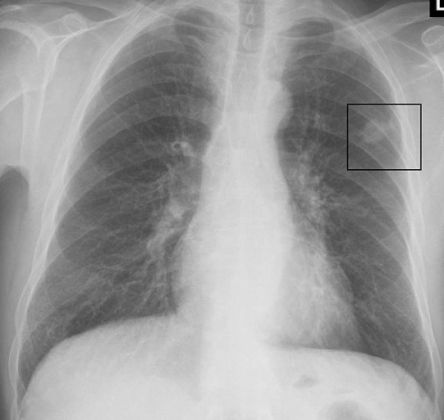 Scenario 3: Si presenta all'attenzione del medico un paziente di 66 anni che sottopone l'immagine della radiografia del proprio torace eseguita qualche settimana prima in previsione di un intervento
