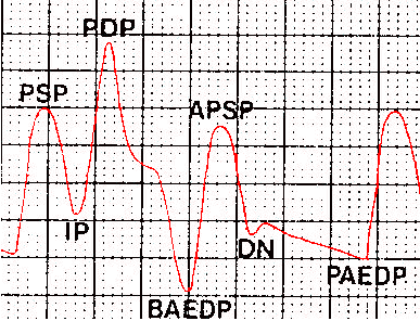 PSP:Picco Pressione Sistolica IP:Insufflazione Pallone PDP:Picco Pressione Diastolica