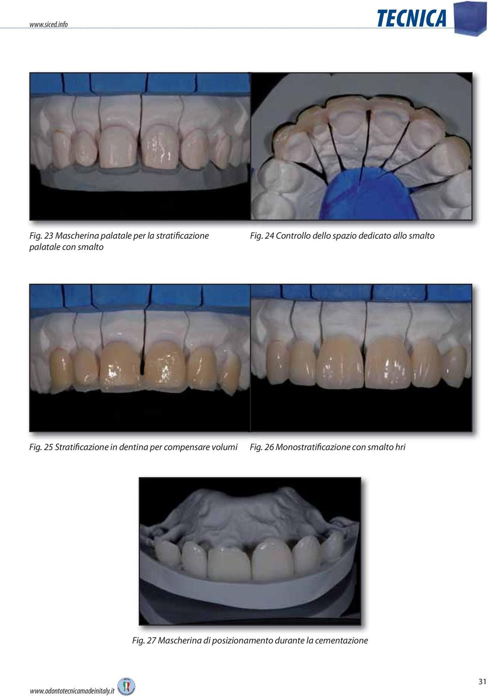 25 Stratificazione in dentina per compensare volumi Fig.