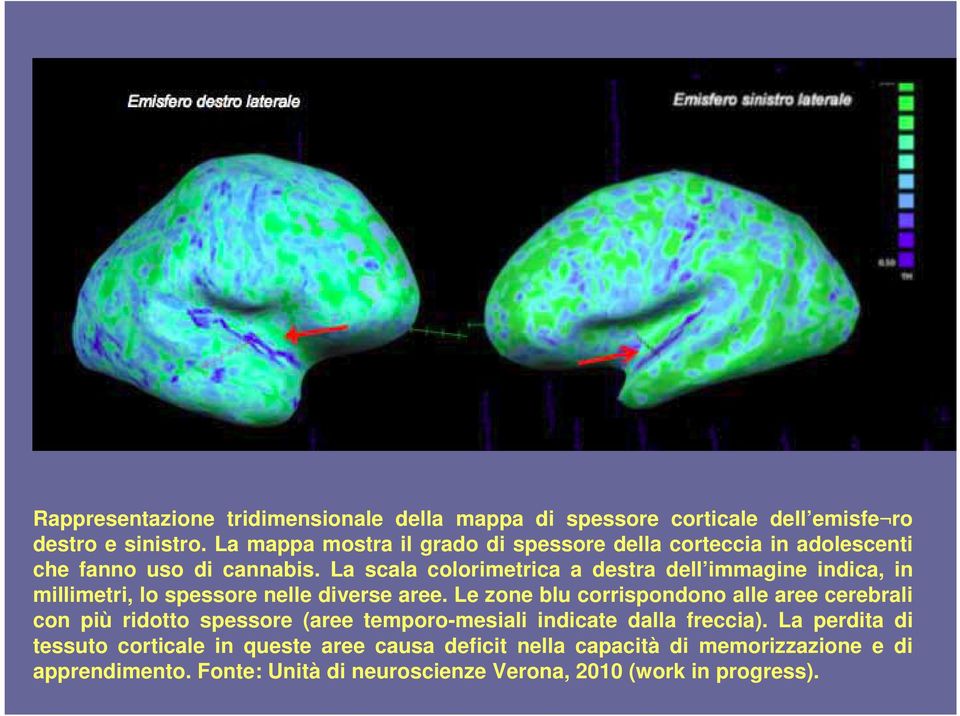 La scala colorimetrica a destra dell immagine indica, in millimetri, lo spessore nelle diverse aree.