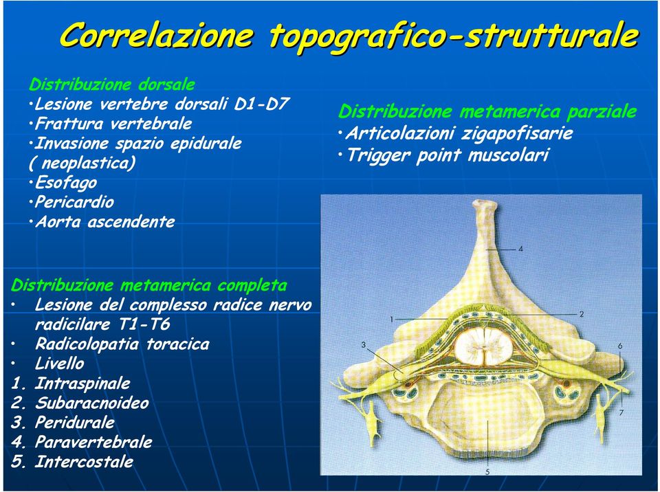 Articolazioni zigapofisarie Trigger point muscolari Distribuzione metamerica completa Lesione del complesso radice