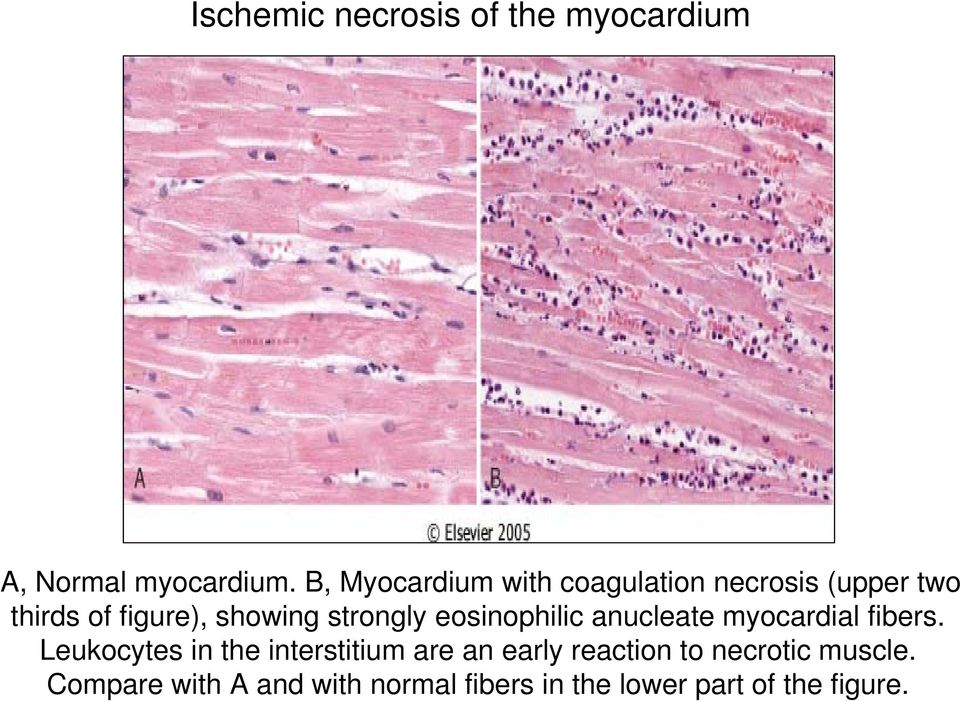 strongly eosinophilic anucleate myocardial fibers.
