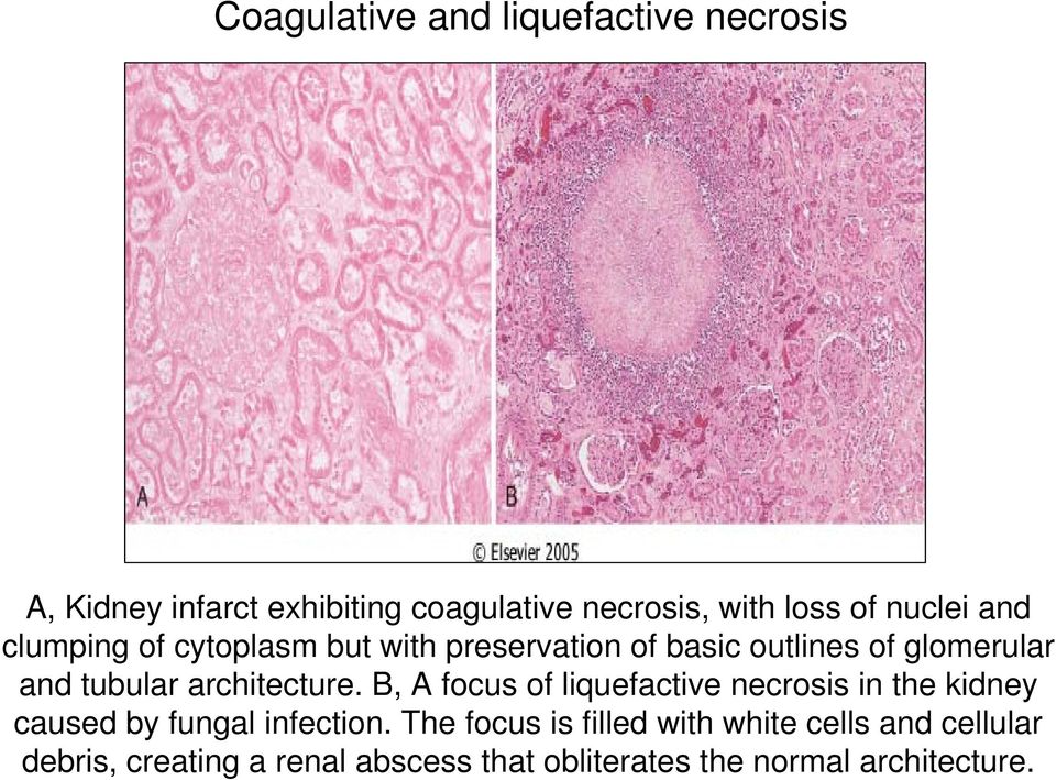 architecture. B, A focus of liquefactive necrosis in the kidney caused by fungal infection.