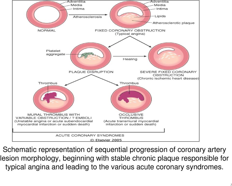 stable chronic plaque responsible for typical angina