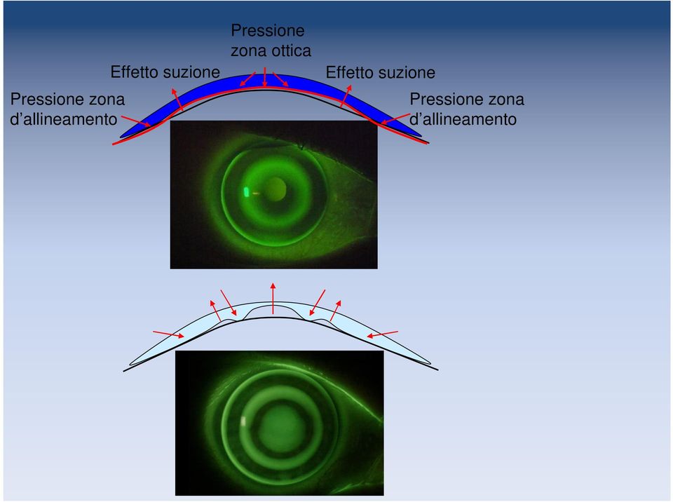 Pressione zona ottica