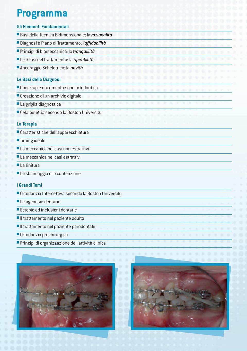 secondo la Boston University La Terapia Caratteristiche dell apparecchiatura Timing ideale La meccanica nei casi non estrattivi La meccanica nei casi estrattivi La finitura Lo sbandaggio e la