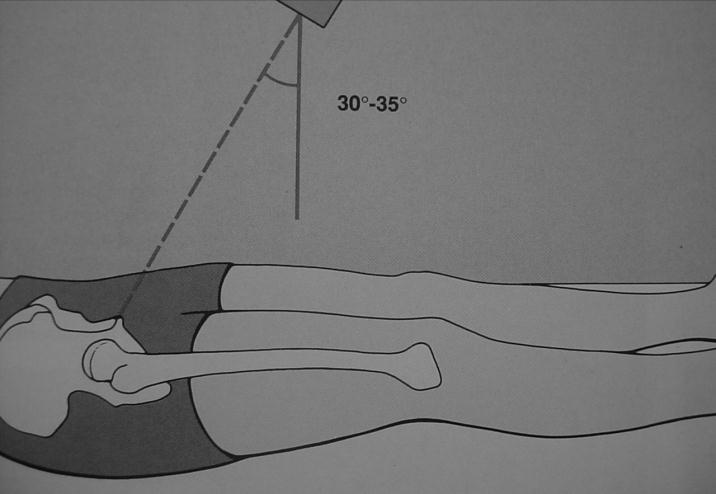 Proiezione outlet Tubo RX inclinazione caudo-craniale 30-45 Deviazioni sul piano coronale