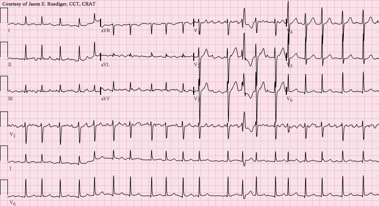 ECG La fibrillazione atriale causa un ulteriore