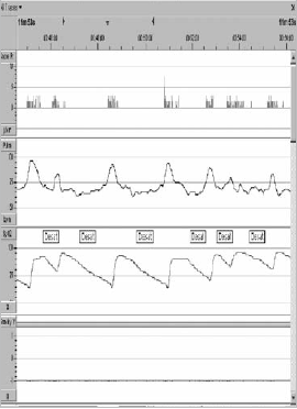 MONITORAGGIO CARDIO- RESP. RIDOTTO Registrazione di 4 parametri: 1. rumore respiratorio o flusso aereo oronasale 2. frequenza cardiaca 3. SaO2 4.