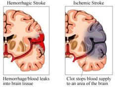 URGENZE CEREBROVASCOLARI Sono la conseguenza di una riduzione critica del flusso sanguigno al cervello.