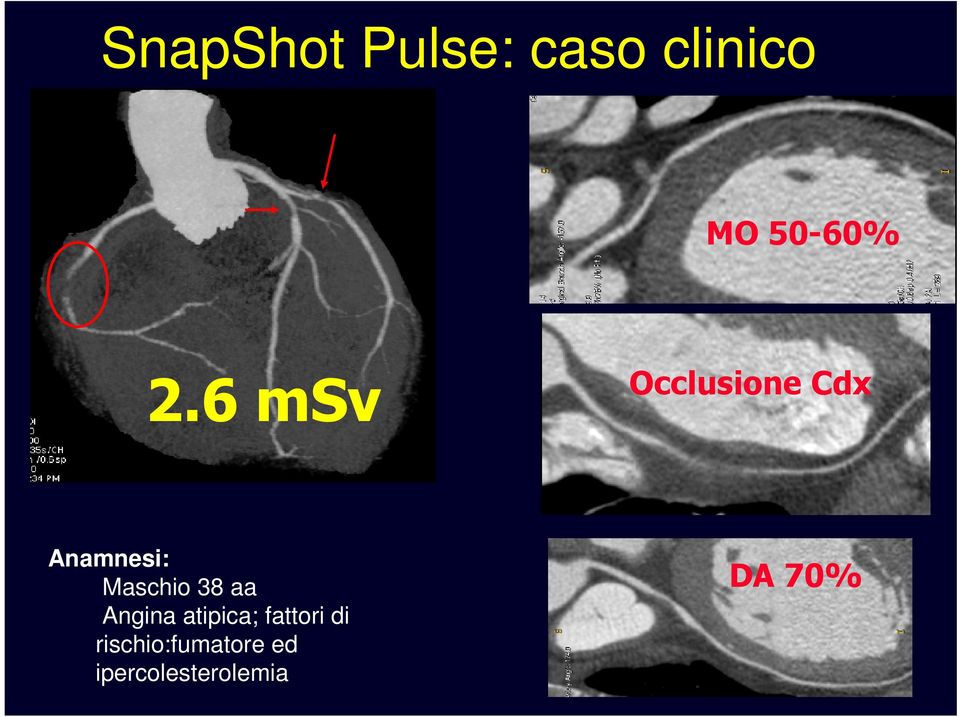 Maschio 38 aa Angina atipica; fattori