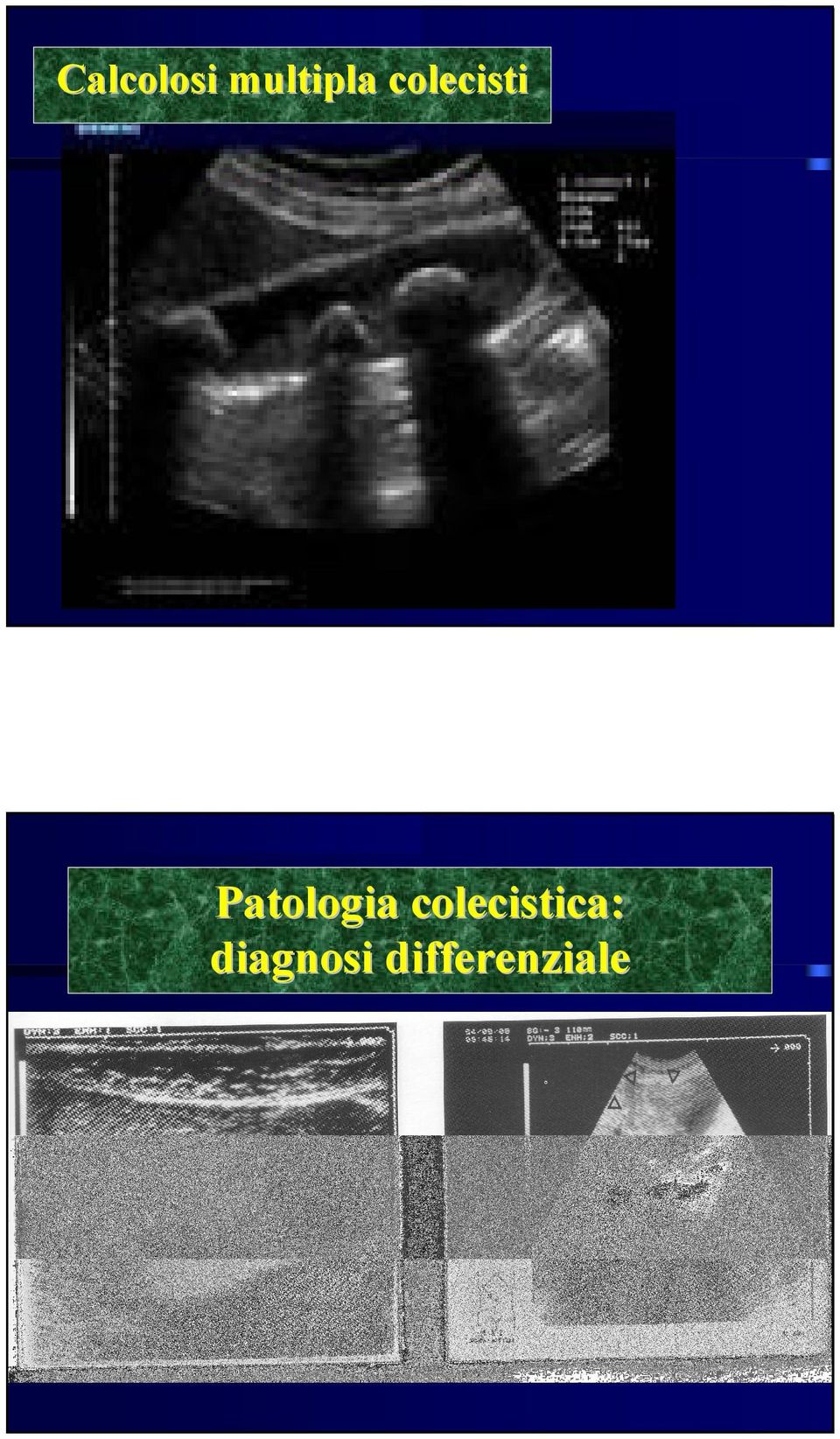 Patologia colecistica colecistica::