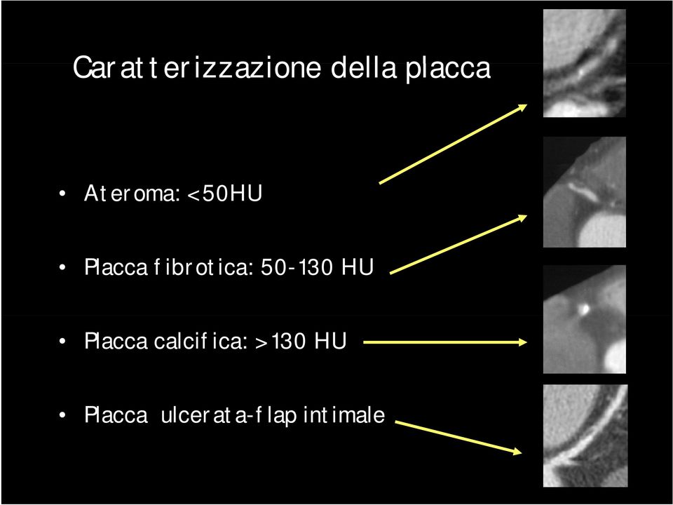 fibrotica: 50-130 HU Placca