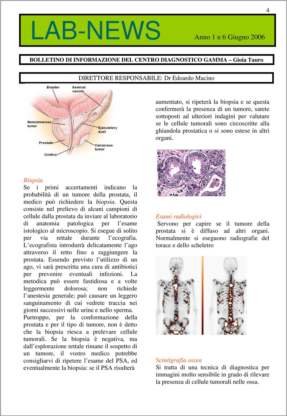 Questa consiste nel prelievo di alcuni campioni di cellule dalla prostata da inviare al laboratorio di anatomia patologica per l esame istologico al microscopio.