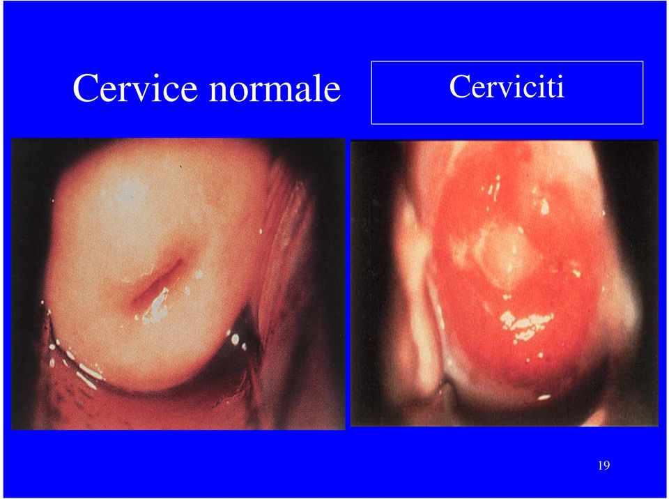Cerviciti