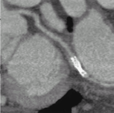 Gli stent coronarici sono ben visibili per la loro struttura ad alta densità tuttavia vi sono artefatti che