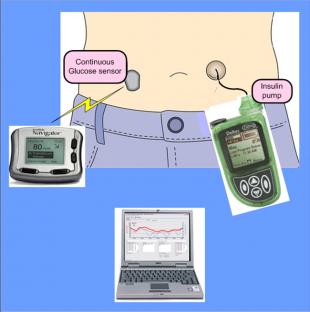 Artificial Pancreas o Closed Loop system Continuous glucose