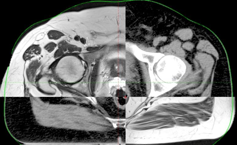 SBRT PROTOCOL MRI T2 after implant SpaceOAR