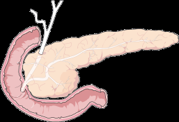 Gluco-lipotossicità glucosio Produzione di glucosio nel fegato Iperglicemia Diabete di tipo 2 FFA=acidi