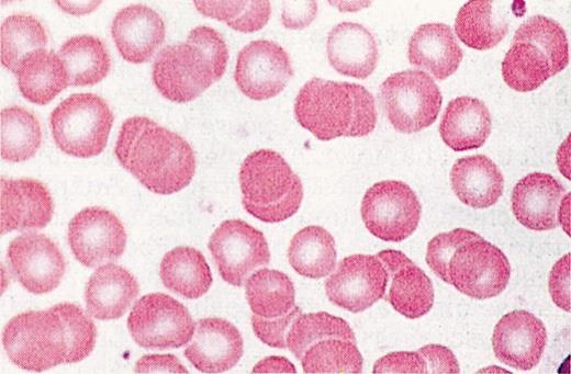 ERITROITI Forma: disco biconcavo anucleato (mancano anche ribosomi)