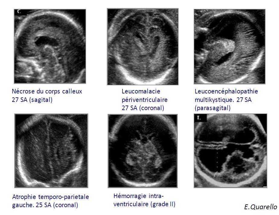 MORBIDITA NEUROLOGICA Quarello