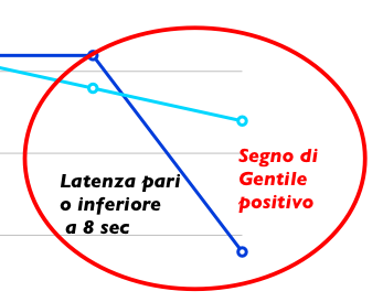 La pressione sul precordio incrementa l acidosi tissutale che si aggrava sino a raggiungere una certa soglia IL RAGGIUNGIMENTO DELLA SOGLIA SCATENA UN SEGNALE DI ALLARME CHE SI PROPAGA IN