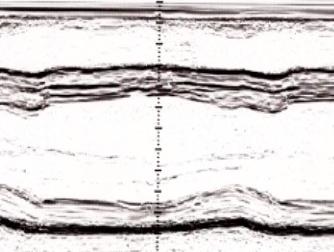 LV wall thickness (mm) 04/12/2013 Variazioni dell ipertrofia Ventricolare Sinistra in un canoista d elite