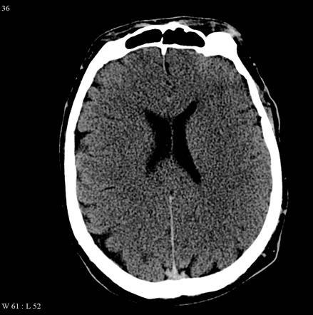 Permeabilità vascolare Si verifica un aumento nella ICP da edema cerebrale dovuto all azione combinata di disfunzione della BEE edema citotossico riduzione del drenaggio del liquor
