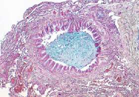 No lung pathology in smokers with