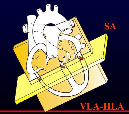 Il cuore non è orientato secondo assi anatomici