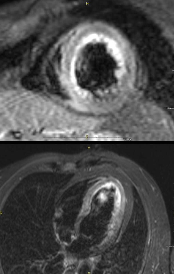 8. T2-weighted imaging In queste sequenze l edema/infiammazione miocardica appare iperintensa Edema Imaging Servono per identificare IMA, miocarditi o delineare aree a rischio d infarto