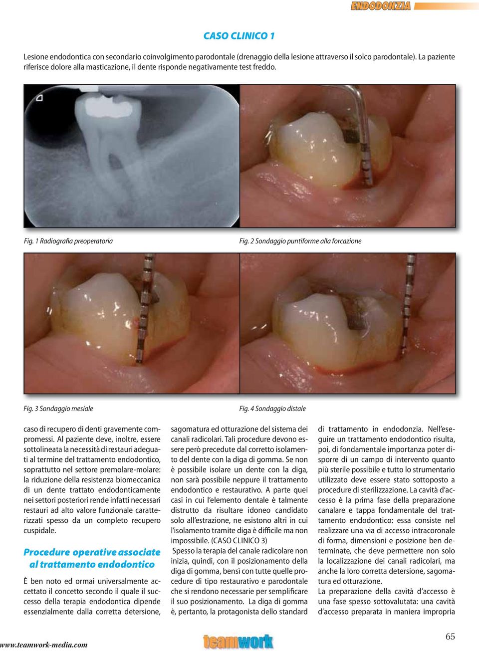 4 Sondaggio distale caso di recupero di denti gravemente compromessi.