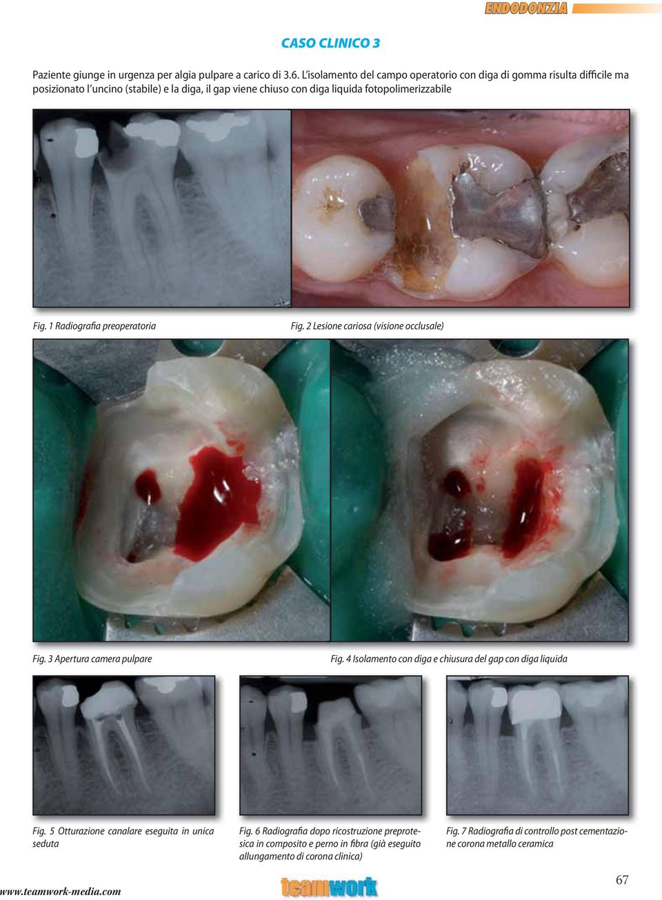 fotopolimerizzabile Fig. 1 Radiografia preoperatoria Fig. 2 Lesione cariosa (visione occlusale) Fig. 3 Apertura camera pulpare Fig.