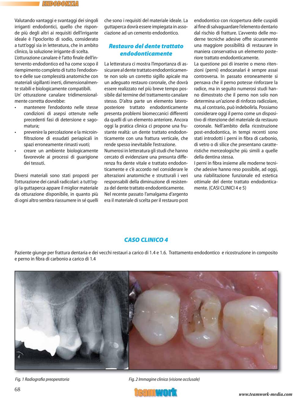 L otturazione canalare è l atto finale dell intervento endodontico ed ha come scopo il riempimento completo di tutto l endodonto e delle sue complessità anatomiche con materiali sigillanti inerti,