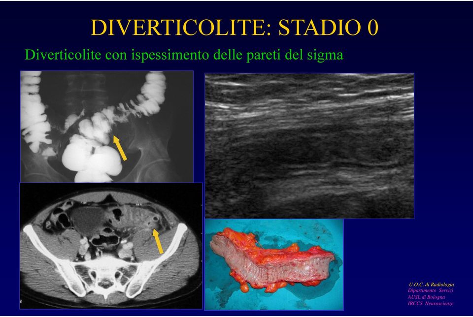 Diverticolite con