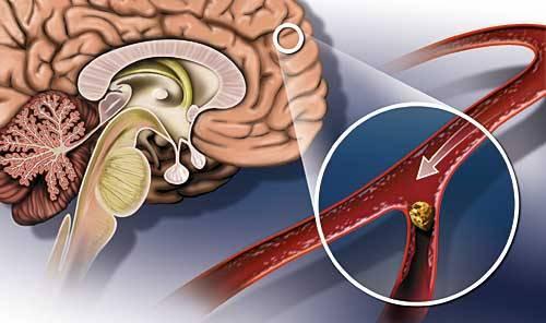 EZIOLOGIA Causa più comune è la malattia vascolare (infarti/ictus ischemici o emorragici nel territorio dell